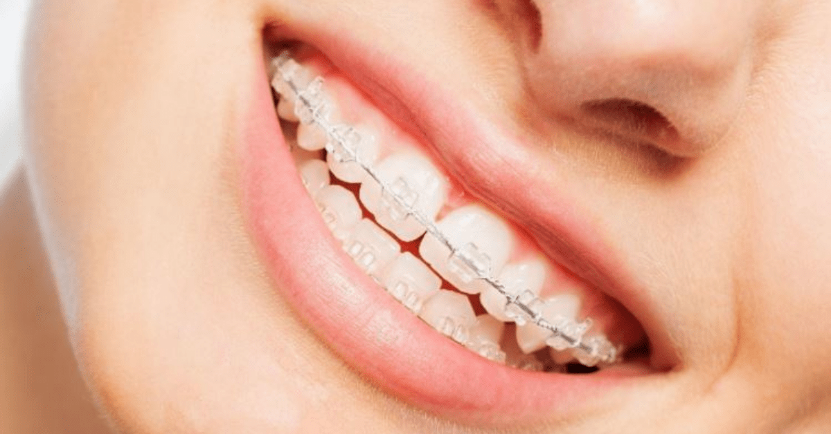 Braces For Adults